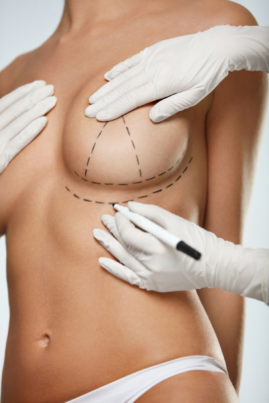breast augmentation αυξητική στήθους